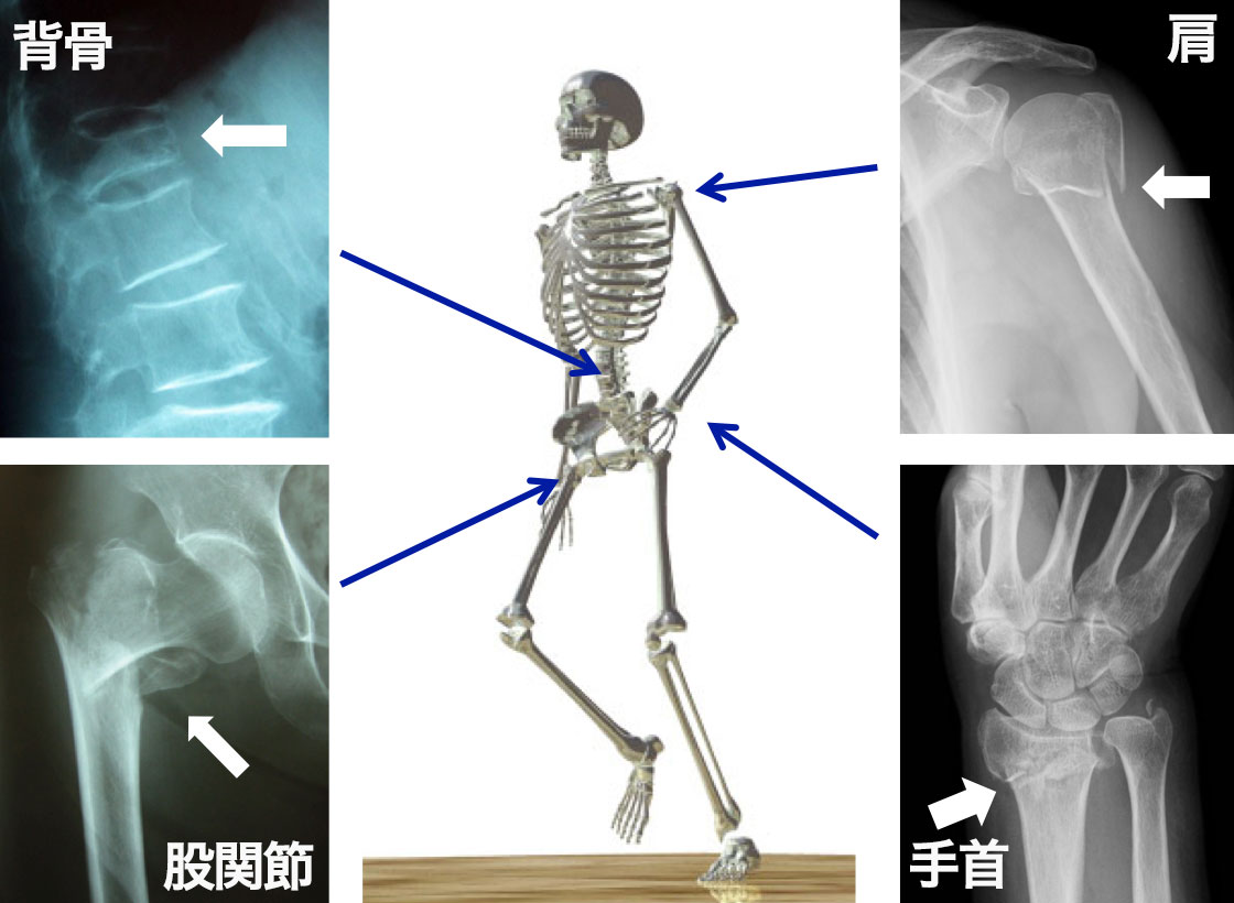 特に注意が必要な背骨、股関節、手首、肩