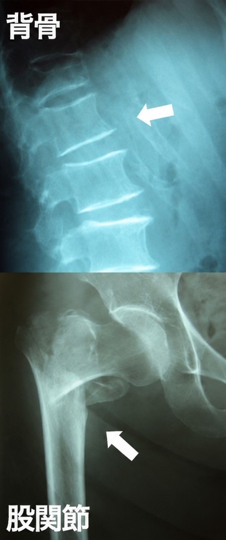 背骨（脊椎圧迫骨折）のレントゲン写真と股関節（大腿骨近位部骨折）のレントゲン写真